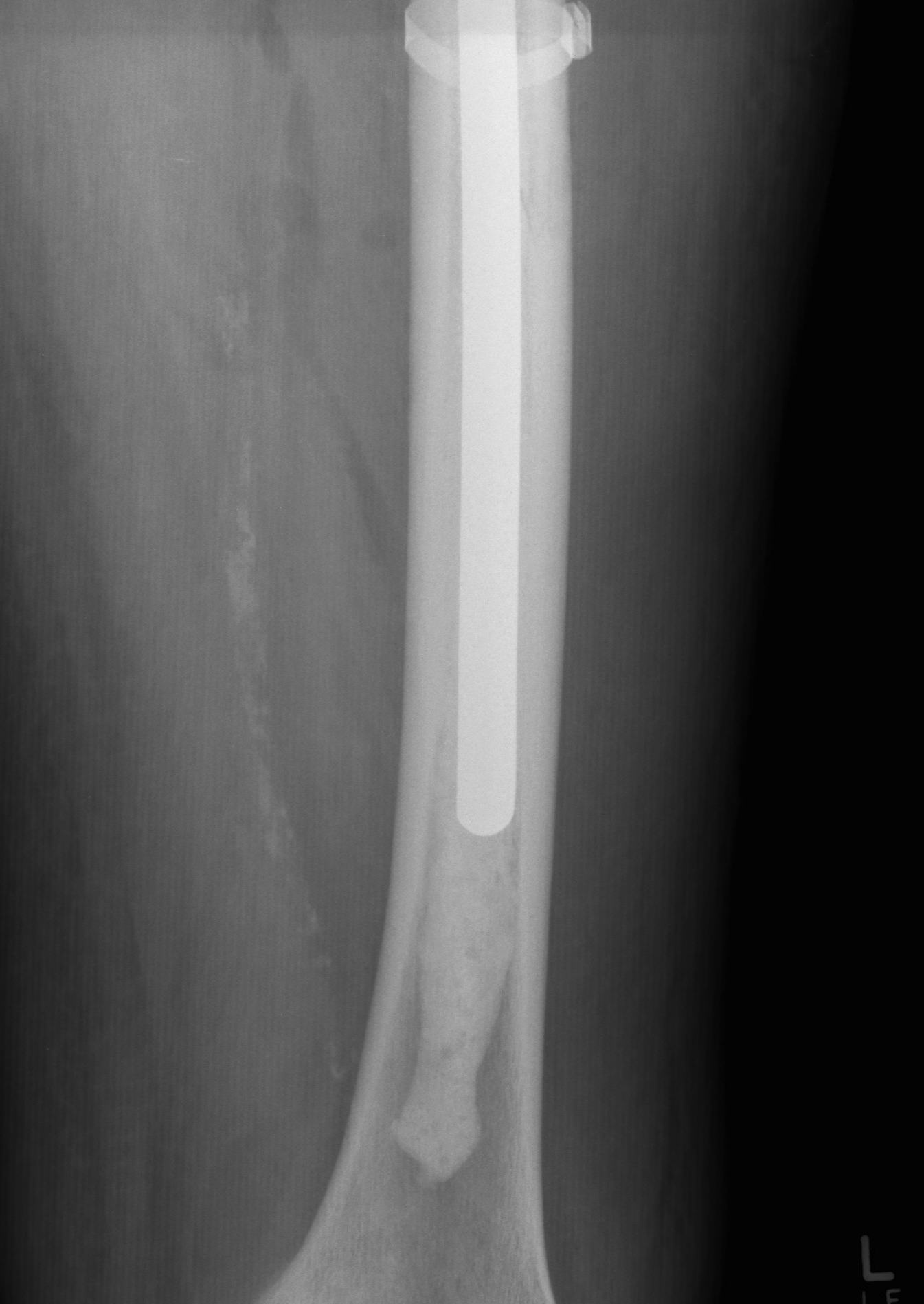 THR Periprosthetic Revision Cemented Femur 2